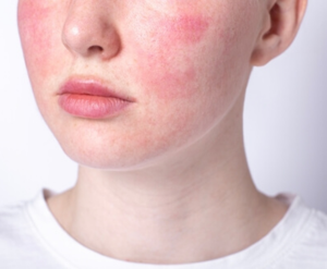 Soothes Inflammation